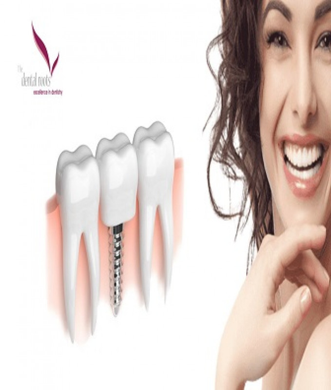 Best Dental implants in India | Dental Implants